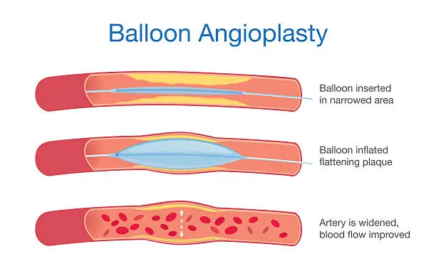 angioplastia grafica - Cómo es la vida después de una angioplastia