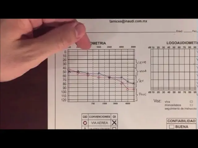 como se lee una grafica de audiometria - Cómo leer los números de los resultados de una prueba de audición