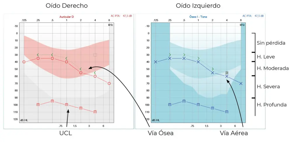 audiometria grafica - Cuáles son los símbolos gráficos que se encuentran en un audiograma