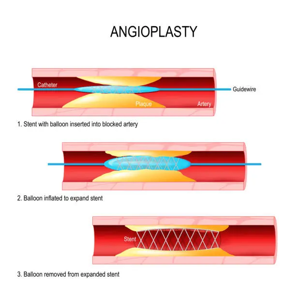 angioplastia grafica - Qué es la angioplastia y para qué sirve