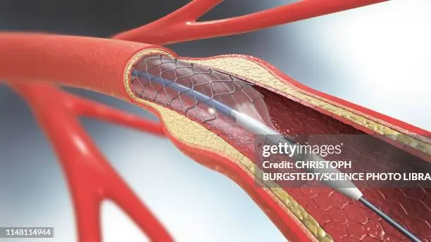 angioplastia grafica - Qué medicamento es bueno para destapar las arterias del corazón