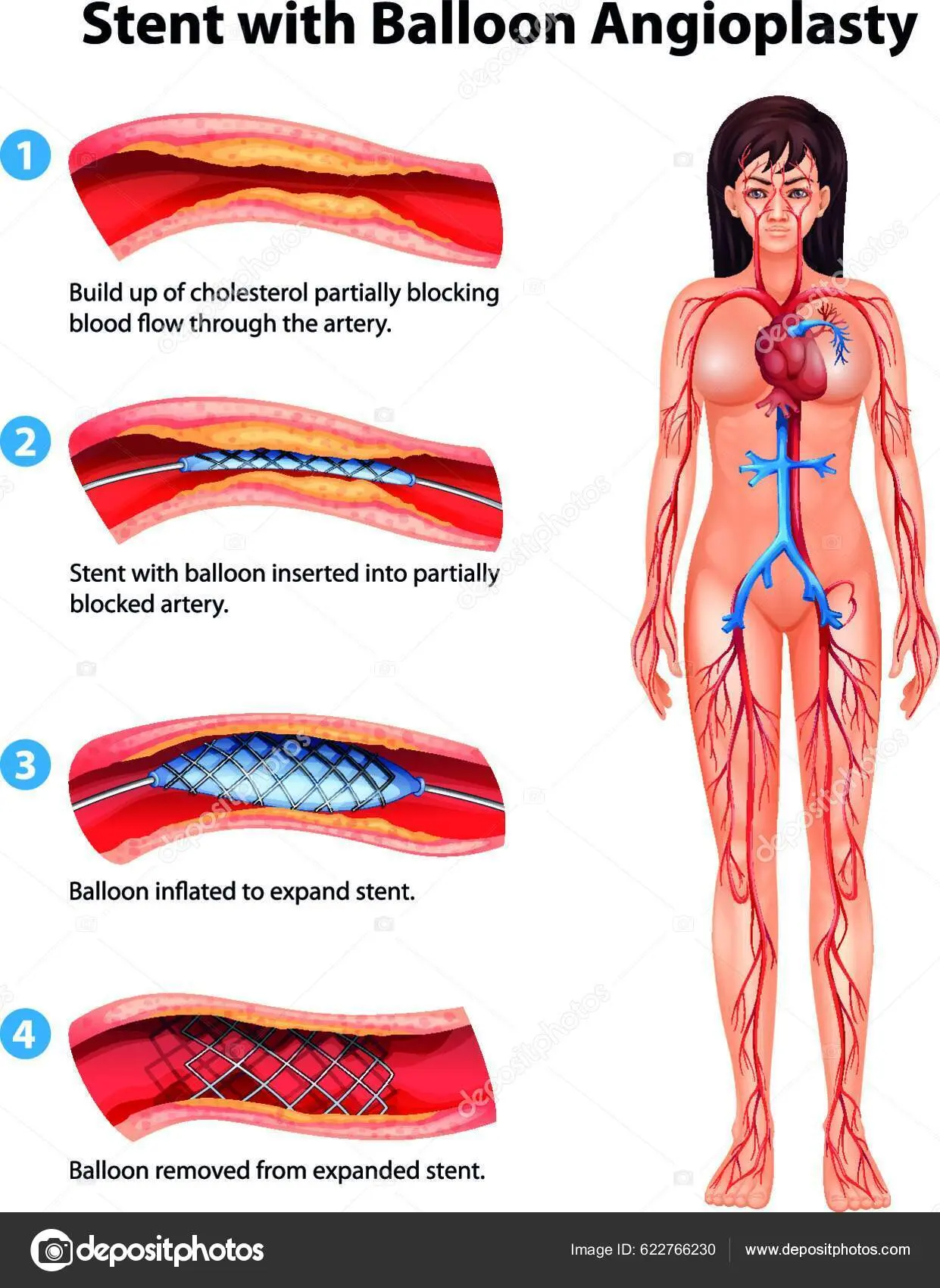 angioplastia grafica - Qué tan riesgosa es una angioplastia